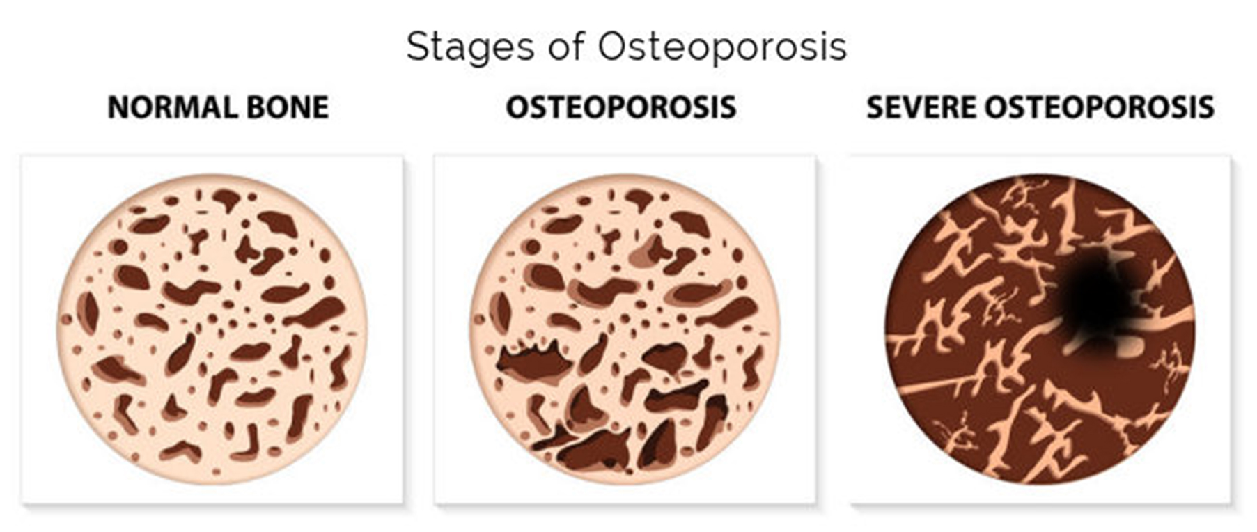 3-stages-osteoporosis-thir-stage