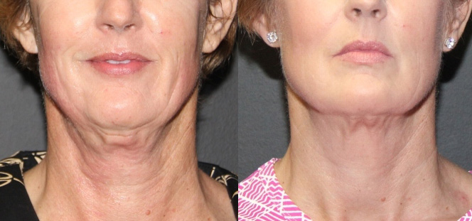 7-EC-Neck-Ultherapy
