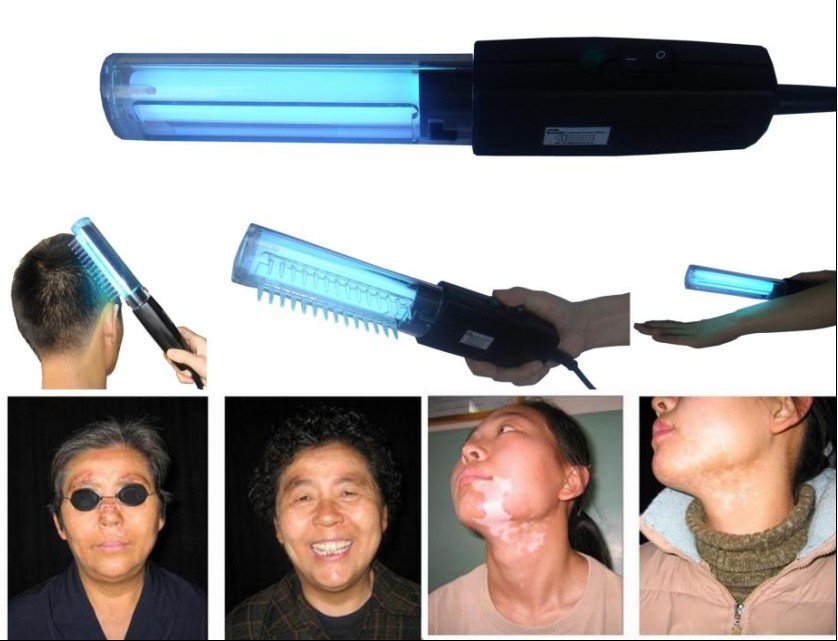 Facial-uv-lamp-Psoriasis-Vitiligo-Eczema-Skin