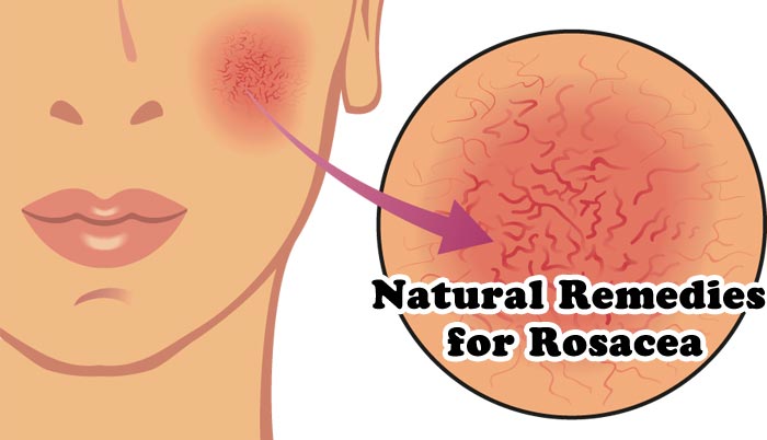 Home Remedies for Rosacea