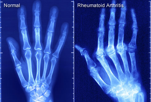 PRinc_rm_x-ray_of_rheumatoid_arthritis