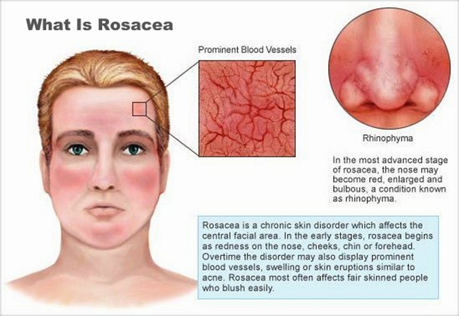 Primary Signs of Rosacea