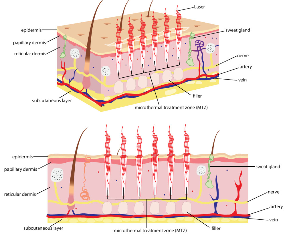 U00bb Lasers Skin Treatments The Facts And Experts Advice