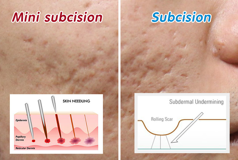 Acne Scars Treatment Subcision Doctor Answers ... - RealSelf