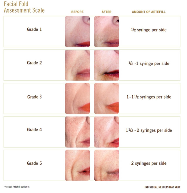 Lip Filler Chart