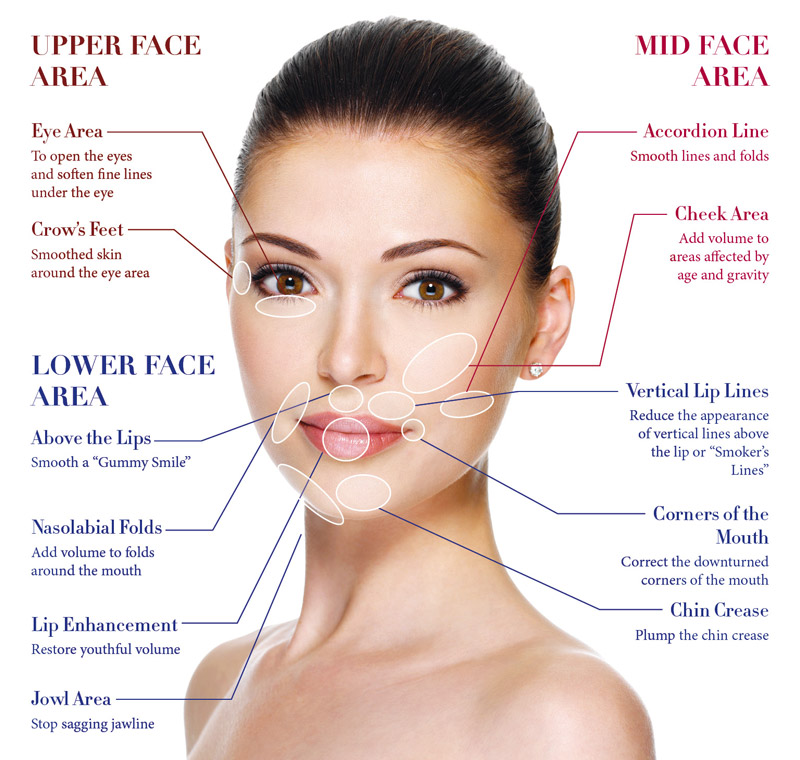 dermal_fillers maping best photo 2016