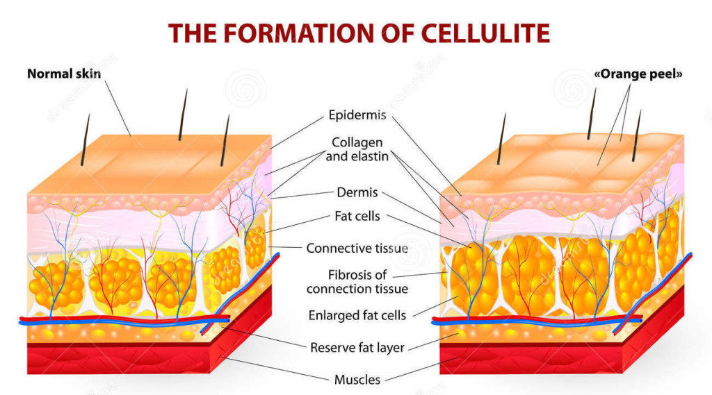 formation-cellulite-vector-diagram-occurs-most-females-rarely-males-34935527