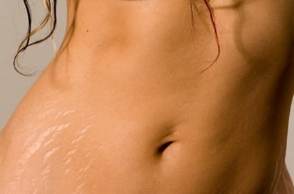 how-to-prevent-stretch-marks-during-pregnancy