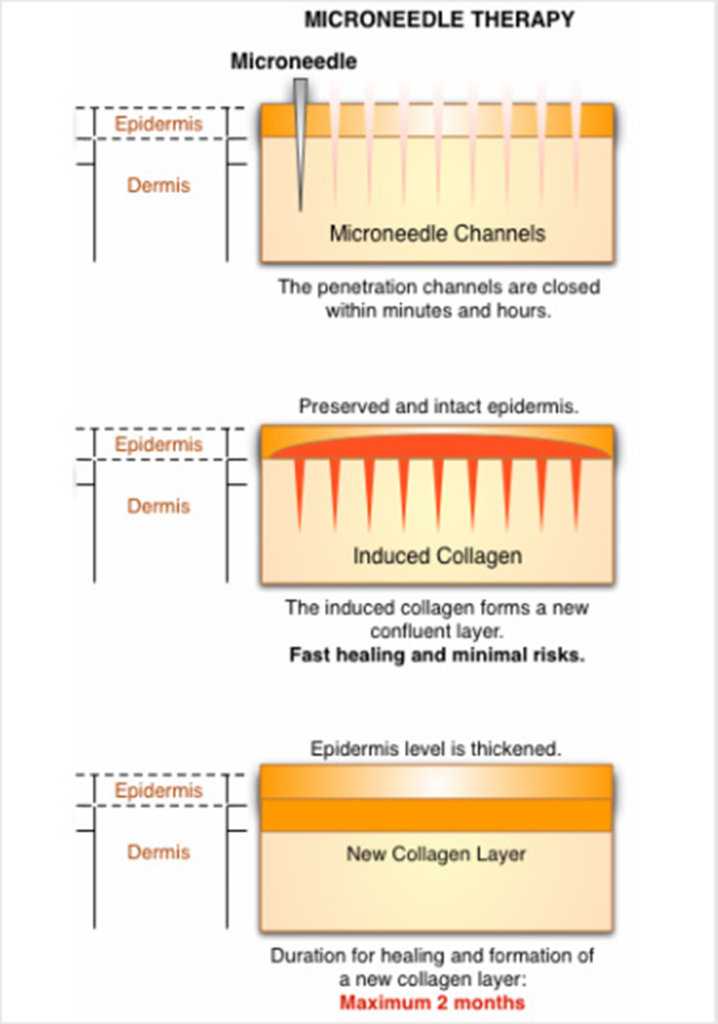 microneedle-layers