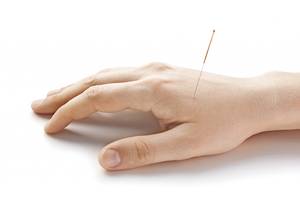 Acupunctured hand (horizontal)