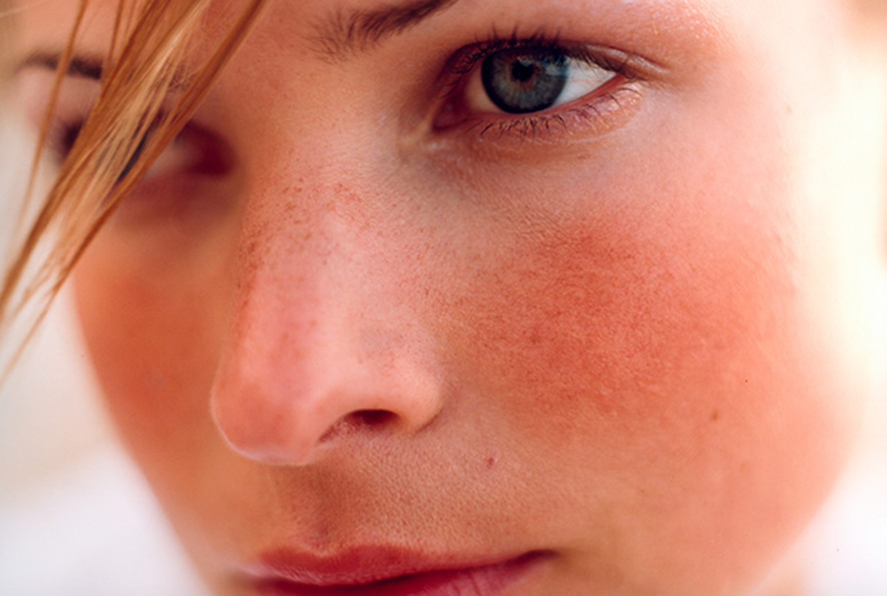 rosacea 5