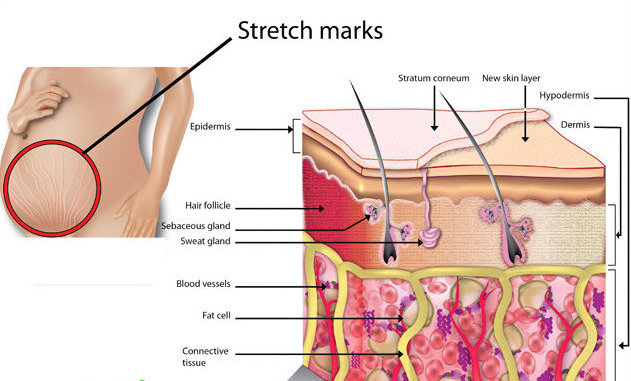 stretch marks